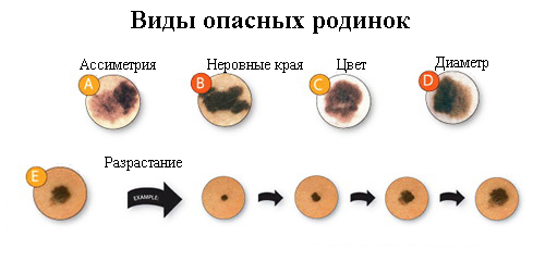 Анализ на вирус папилломы человека у женщин спб